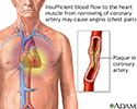 Stable angina