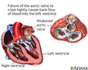 Aortic insufficiency