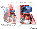 Left atrial myxoma
