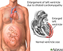 Peripartum cardiomyopathy