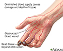 Thromboangiitis obliterans