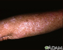 Actinic keratosis on the arm