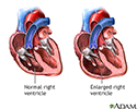 Tricuspid Regurgitation