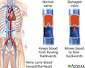 Venous insufficiency