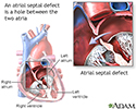 Atrial septal defect