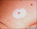 Halo nevus