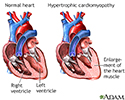 Hypertrophic cardiomyopathy