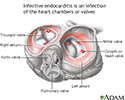 Infective endocarditis
