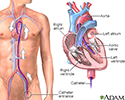 Left heart catheterization