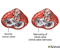 Mitral stenosis