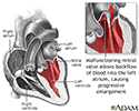 Mitral valve prolapse