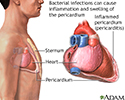 Bacterial pericarditis