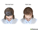 Female-pattern baldness