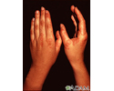 Erythema multiforme, circular lesions - hands