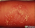 Pustules - superficial on the arm