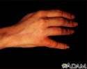 Staphylococcal lymphangitis
