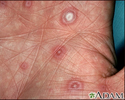 Erythema multiforme, target lesions on the palm