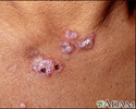 Lupus, discoid  - view of lesions on the chest