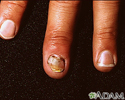 Nail infection - candidal