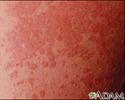 Tinea versicolor - close-up