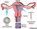 Birth control methods