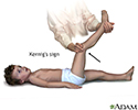 Kernig's sign of meningitis