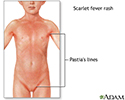 Signs of scarlet fever