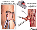 Skin graft