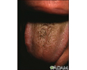 Black hairy tongue