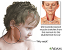 Torticollis (wry neck)