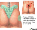 Areas where bedsores occur