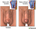 Penis - with and without foreskin