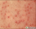 Keratosis pilaris - close-up