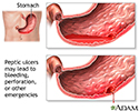 Ulcer emergencies