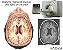 MRI of the brain