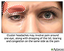 Pain of cluster headache