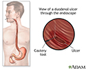 Gastroscopy procedure