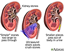 Lithotripsy procedure