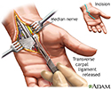 Carpal tunnel surgical procedure