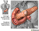 Cause of peptic ulcers