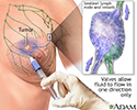 Sentinel node biopsy