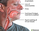 Anaphylaxis