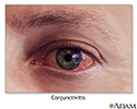Conjunctivitis