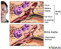 Middle ear infection (otitis media)