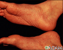 Reactive arthritis - view of the feet