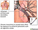 Causes of chronic bronchitis