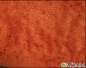 Xerosis - close-up