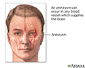 Cerebral aneurysm