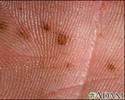 Basal cell nevus syndrome - close-up of palm
