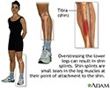 Shin splints
